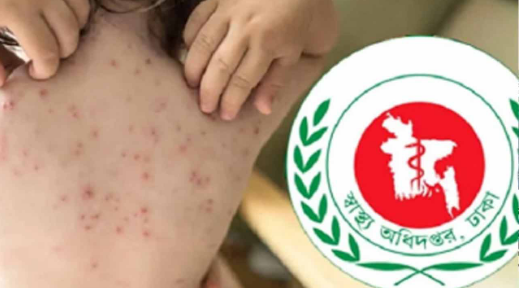 আরও ৫ শিশুর মৃত্যু  হাম ও হামের উপসর্গে