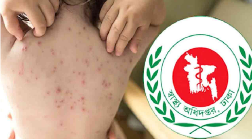 হাম ও হামের উপসর্গ নিয়ে আরও ৬ শিশুর মৃত্যু