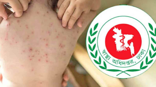 দেশে ২৪ ঘণ্টায় হাম উপসর্গে আরও ১৭ শিশুর মৃত্যু