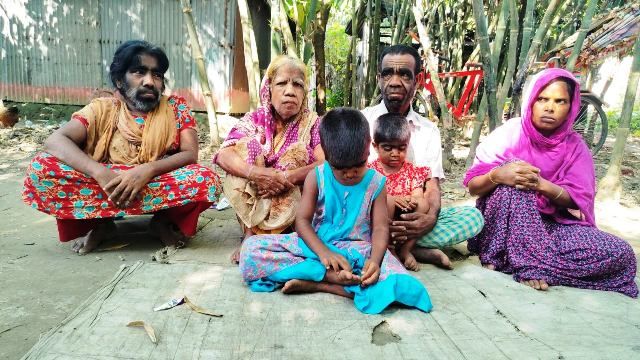 ইসলামপুরে শরীরে প্রাণীদের মত লোম নিয়ে তিনটি পরিবারের মানবেতর জীবন-যাপন