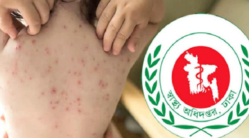দেশে হাম ও হামের উপসর্গে আরও ১২ শিশুর মৃত্যু