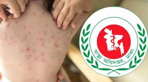 হাম ও হামের উপসর্গ নিয়ে আরও ৭ শিশুর মৃত্যু
