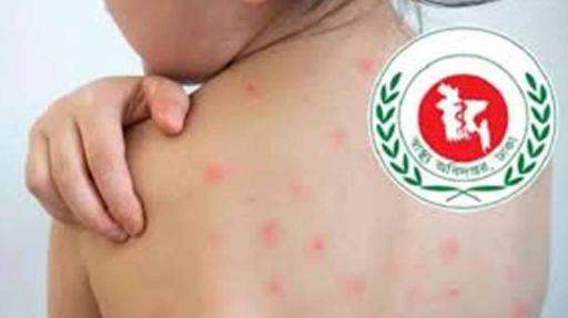 হামের উপসর্গ নিয়ে আরও ৪ শিশুর মৃত্যু
