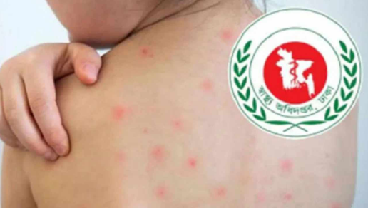 হাম ও হামের উপসর্গ নিয়ে আরও ১০ জনের মৃত্যু